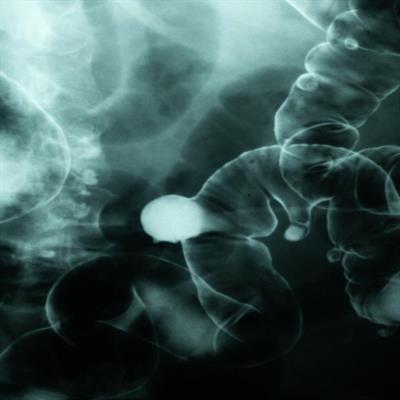 O que é 'síndrome do intestino permeável'