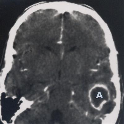 Abcesso cerebral, Sintomas e Tratamento