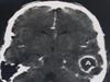 Abcesso cerebral, Sintomas e Tratamento
