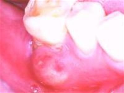 Abcesso dentário, Sintomas e Tratamento