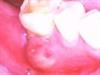Abcesso dentário, Sintomas e Tratamento