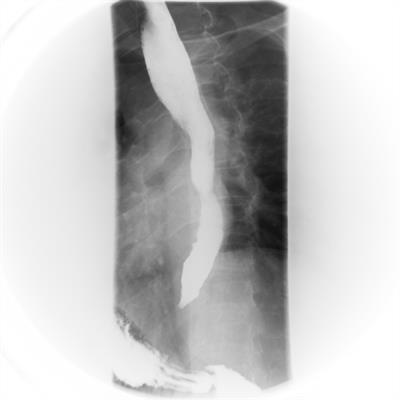 O que é Acalasia