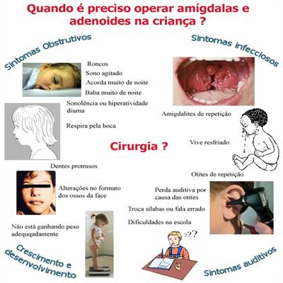O que é Adenóides e adenoidectomia