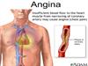 O que é Angina