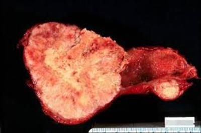 cancerul biliar cancer cauze genetice