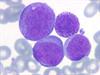 O que é Leucemia aguda mielóide
