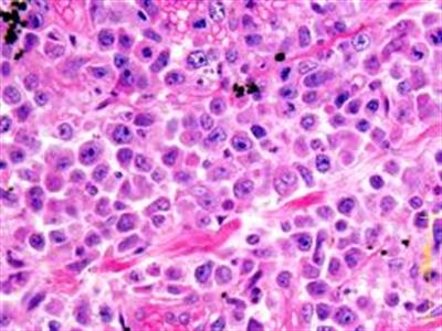 Leucemia de células pilosas