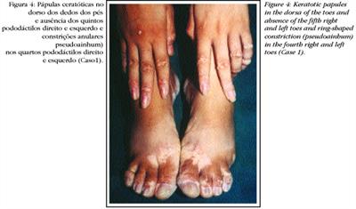 Paraplegia espástica hereditária