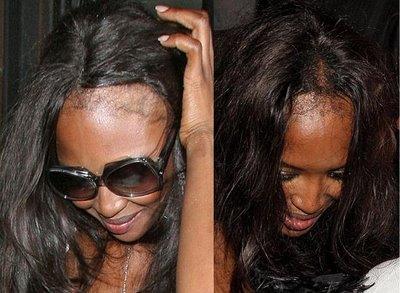 Perda de cabelo, como prevenir e tratar