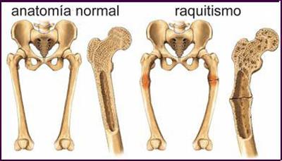 Raquitismo - Fraqueza muscular, ossos fracos e deformidade