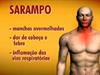 Sarampo, como tratar, sintomas e infecção
